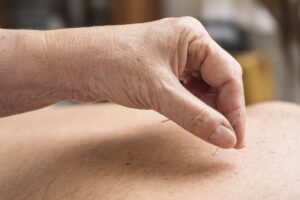 Acupuntura
